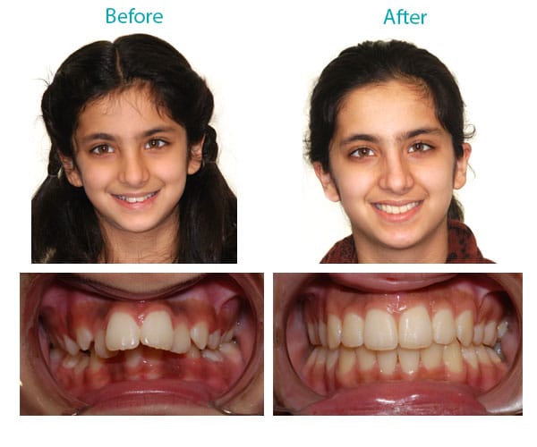 Before and After Burlington Orthodontics Burlington MA Braces