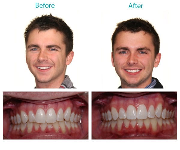 Before and After Burlington Orthodontics Burlington MA Braces