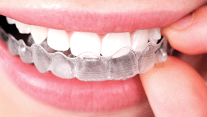 Invisalign Clear Braces in Burlington ON - Orthodontic Treatment