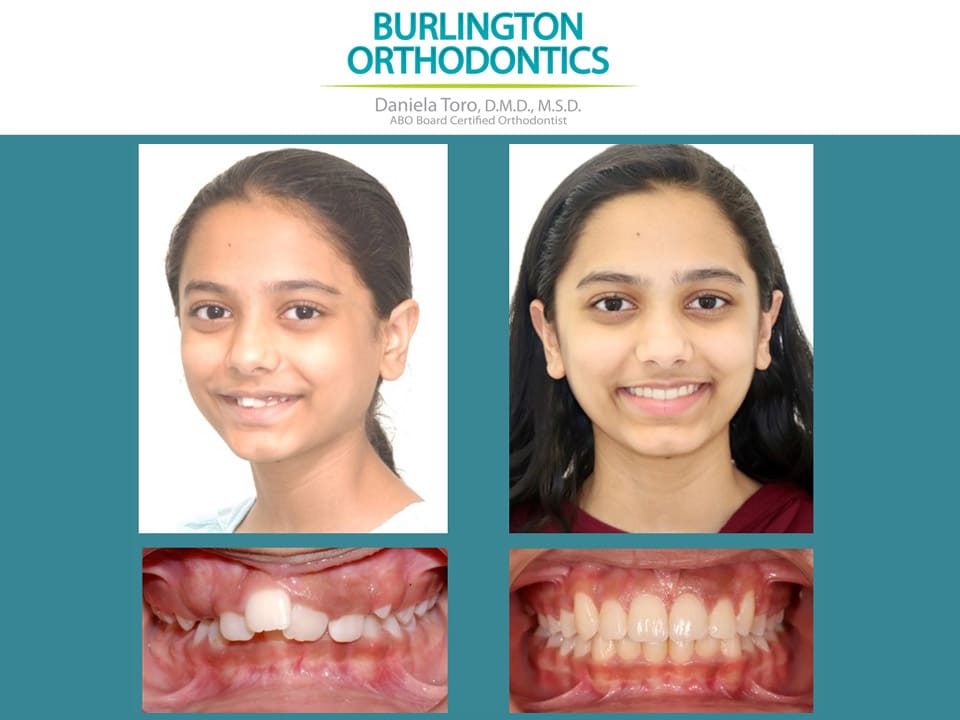Before and After Photos Burlington Orthodontics in Burlington, MA