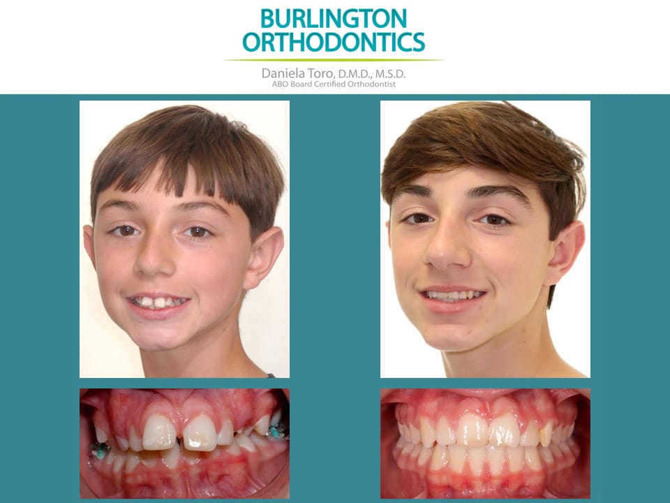 Before and after treatment at Burlington Orthodontics in Burlington, MA
