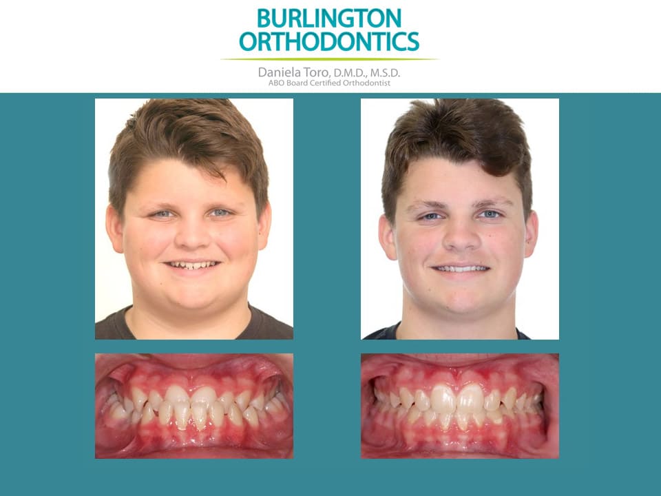 Before and after treatment at Burlington Orthodontics in Burlington, MA