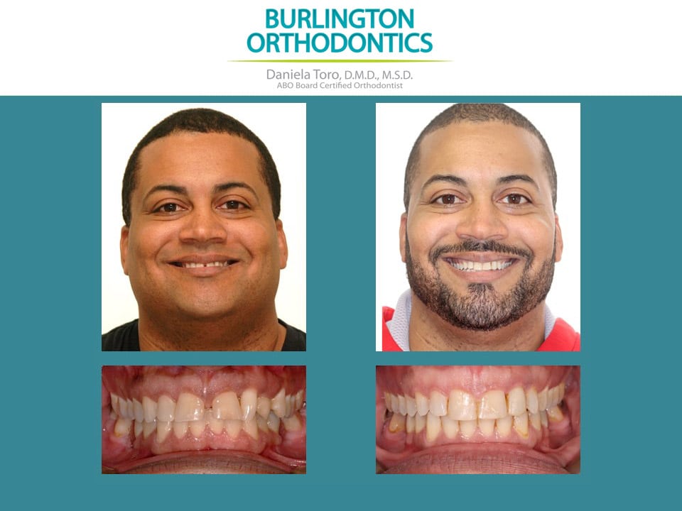 Before and after treatment at Burlington Orthodontics in Burlington, MA