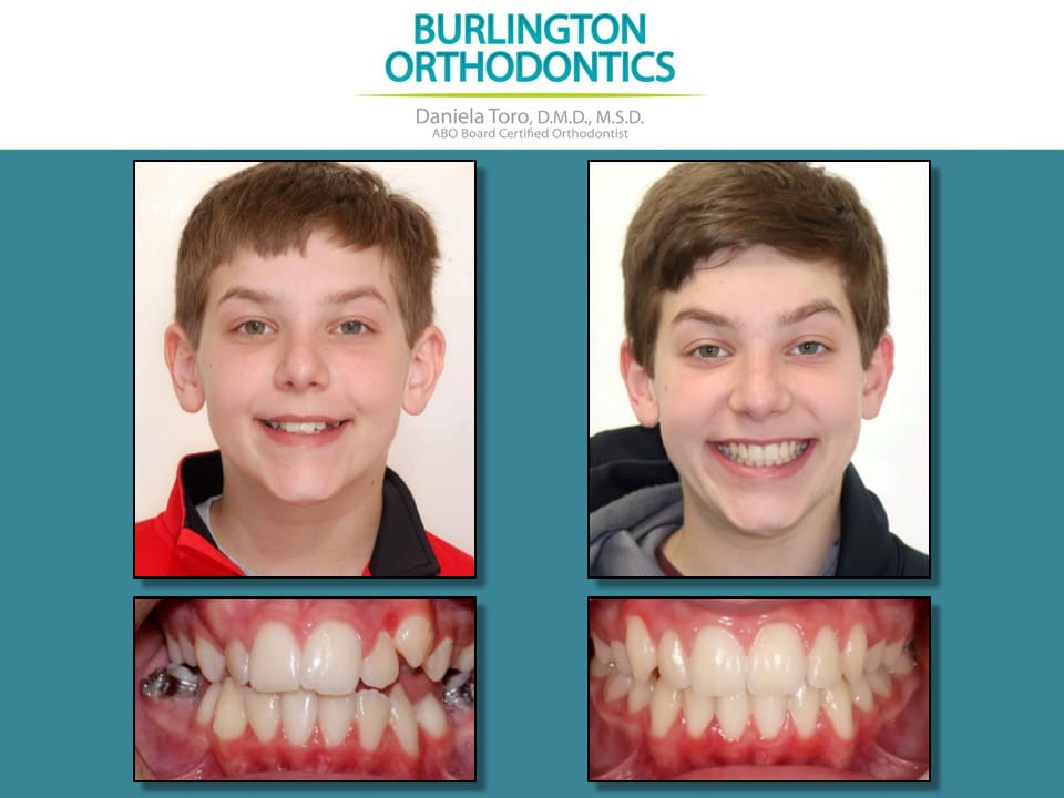 Before and after treatment at Burlington Orthodontics in Burlington, MA