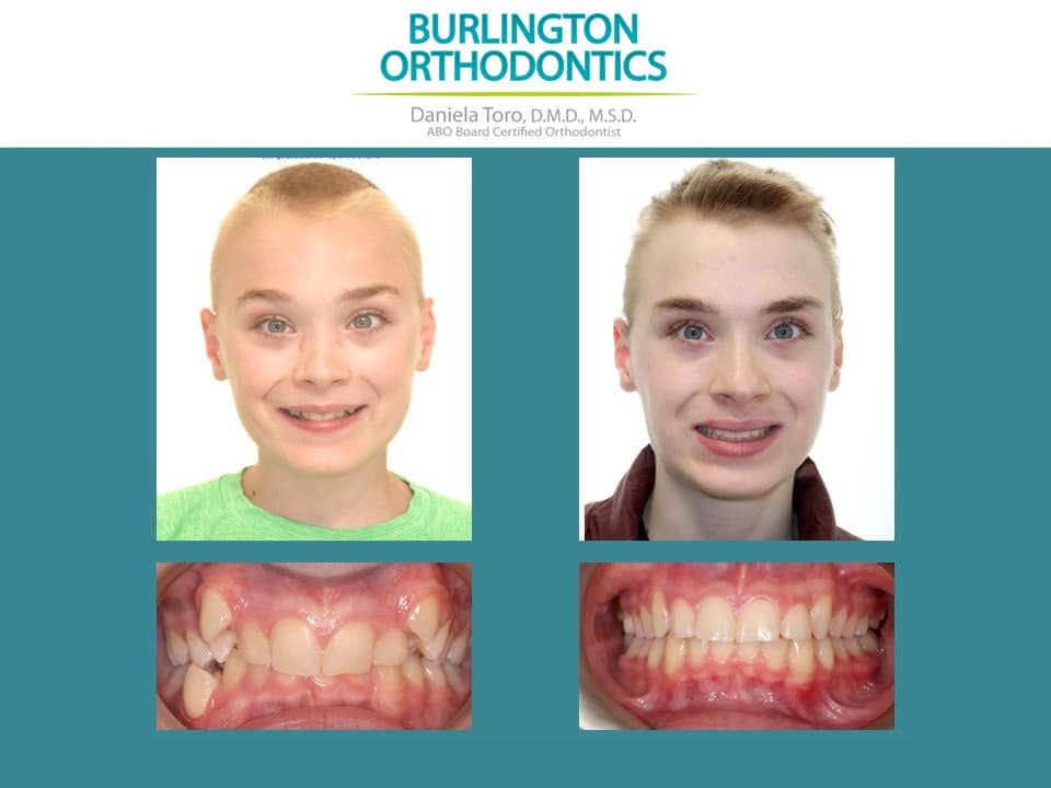 Before and after treatment at Burlington Orthodontics in Burlington, MA