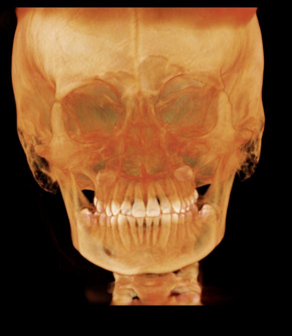 CBCT3
