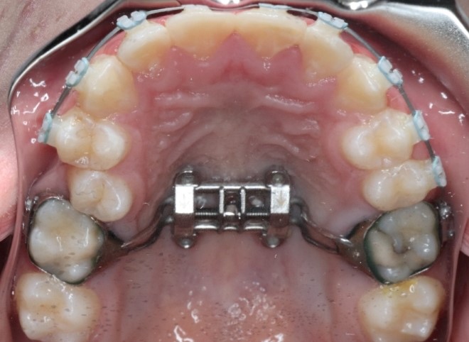 MSE Patient 2 Progress Number 2